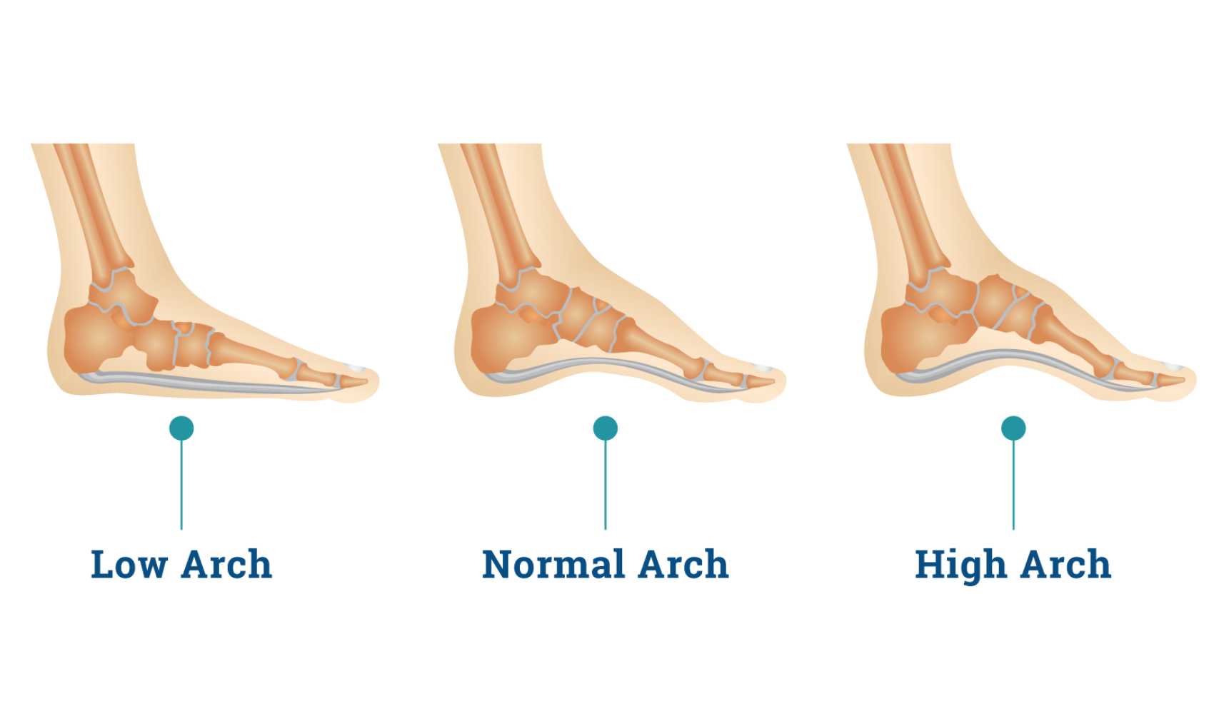 How Can You Improve Arch Support? Cincinnati Foot Ankle Care ...